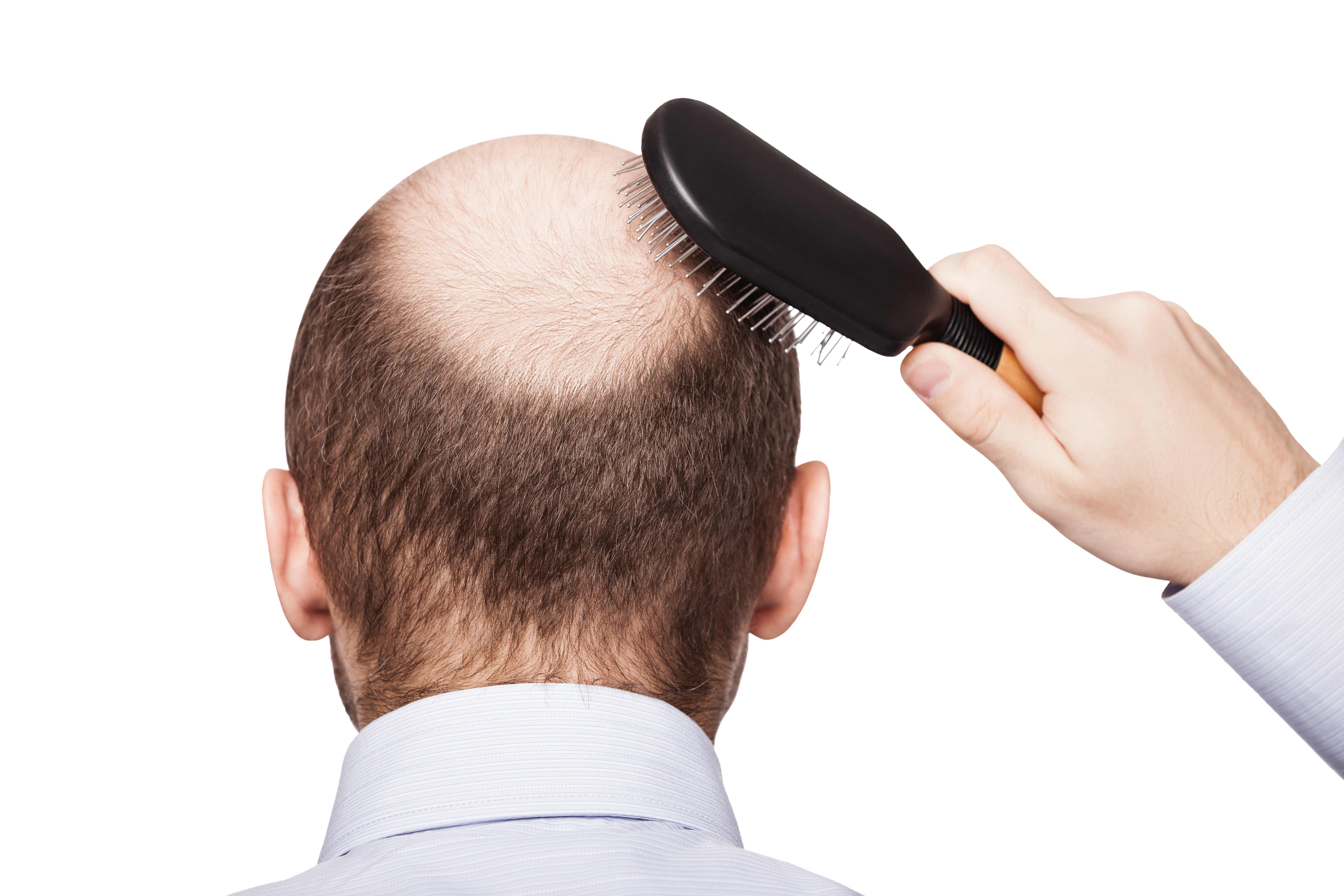 câu hỏi thường gặp về rụng tóc ở nam giới