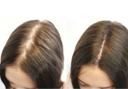 6 cách kích thích mọc tóc nhanh tại nhà  bằng nguyên liệu tự nhiên