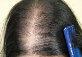 Bị rụng tóc ở đỉnh đầu nên điều trị thế nào?