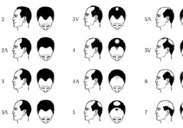 Hiểu rõ về cách chữa rụng tóc theo từng cấp độ