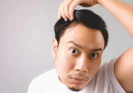 5 cách chữa hói đầu tại nhà hiệu quả nhất