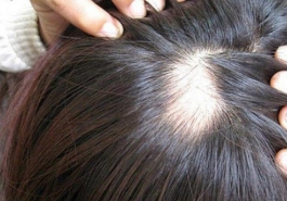 Cách chữa rụng tóc từng mảng hiệu quả nhất
