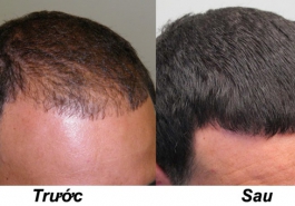 Tổng hợp phương pháp chữa bệnh rụng tóc hói đầu một cách triệt để