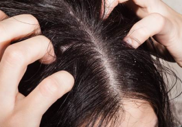 5 cách chữa dứt điểm chứng rụng tóc cho da đầu dầu