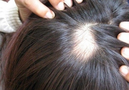 Chân tóc yếu dễ rụng phải làm sao?