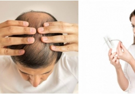 Bệnh rụng tóc và cách chữa trị hiệu quả tại nhà