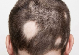 Bệnh rụng tóc có lây không?