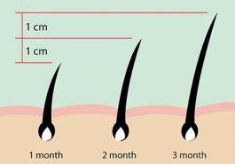 Cách trị rụng tóc hiệu quả nhất - Nên lấy nang tóc làm gốc