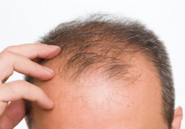 Hói đầu sớm ở nam giới là biểu hiện của bệnh gì?
