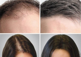 Làm sao để ngăn rụng tóc hiệu quả nhất?