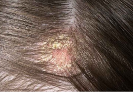 Bệnh nấm da đầu và những cách điều trị tại nhà tận gốc đơn giản