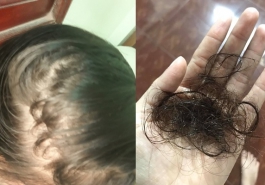 Những nguy hại từ việc rụng tóc có thể bạn chưa biết