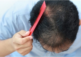 Nguyên nhân và cách khắc phục bệnh rụng tóc hiệu quả nhất