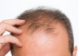 Rụng tóc nhiều ở nam giới là bệnh gì và các giải pháp chữa trị