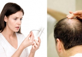 Người bị rụng tóc nhiều uống thuốc gì an toàn, hiệu quả?