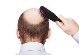 Rụng tóc ở nam giới: Những câu hỏi thường gặp