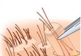 Trị hói bằng phương pháp cấy tóc: hói vẫn có thể hoàn hói