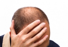 Vì sao rụng tóc do di truyền chỉ gặp ở nam giới?