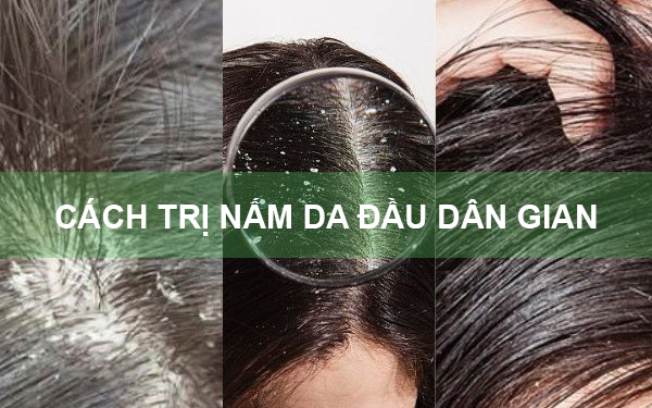 6 cách trị nấm da đầu dân gian hiệu quả và an toàn ngay tại nhà