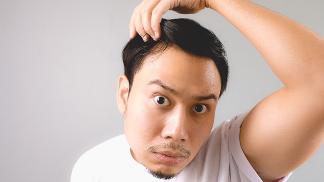 5 cách chữa hói đầu tại nhà hiệu quả