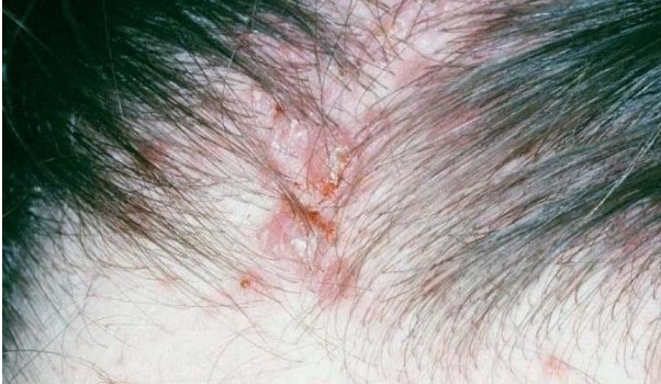 Bệnh ngoài da gây rụng tóc