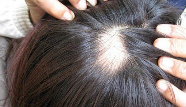 Cách chữa rụng tóc từng mảng