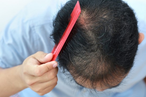 Cách điều tri bệnh rụng tóc ở nam giới