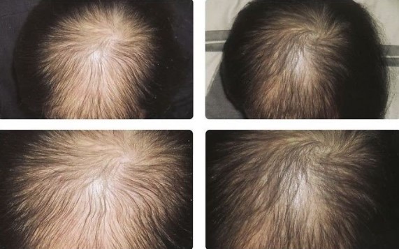 Cách mọc tóc nhanh trong 1 tuần cho nam  Dài 2  3cm chỉ trong 7 ngày