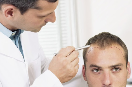 Điều trị rụng tóc ở nam giới