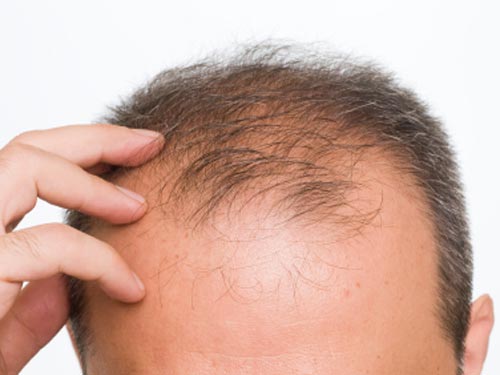 hói đầu sớm ở nam giới là biểu hiện của bệnh gì?