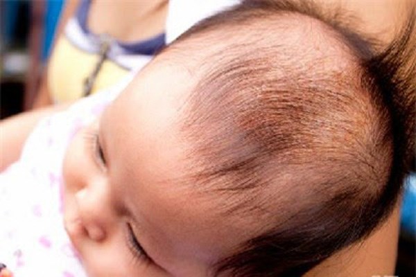 Nấm da đầu là tình trạng trẻ em hay gặp phải