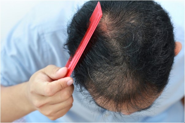 Nguyên nhân bệnh rụng tóc và cách khắc phục