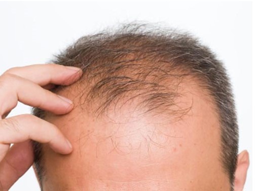 Rụng tóc là biểu hiện của bệnh gì? 