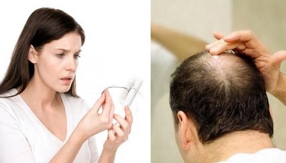 Thiếu chất là nguyên nhân hàng đầu dẫn đến rụng tóc