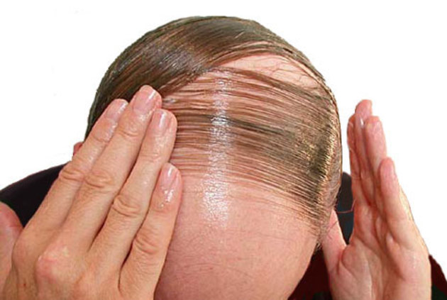 những nguyên nhân gây rụng tóc ở nam giới và nữ giới