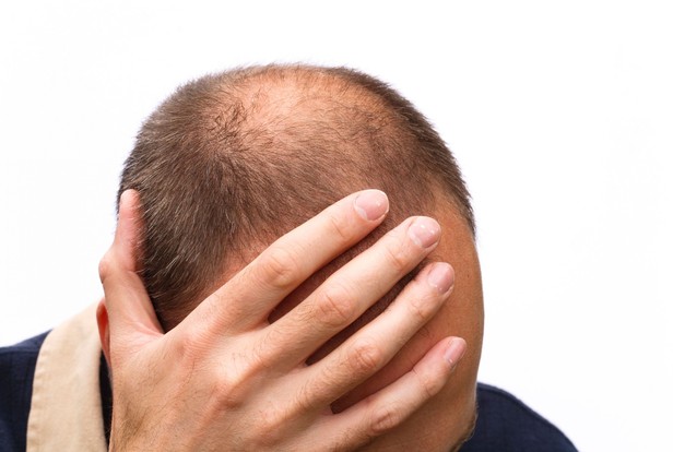 thủ phạm gây ra rụng tóc do di truyền ở nam giới